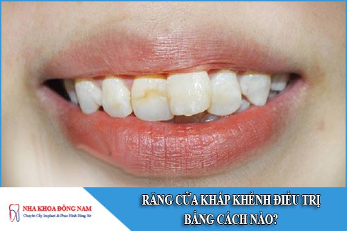 Răng cửa khấp khểnh điều trị bằng cách nào