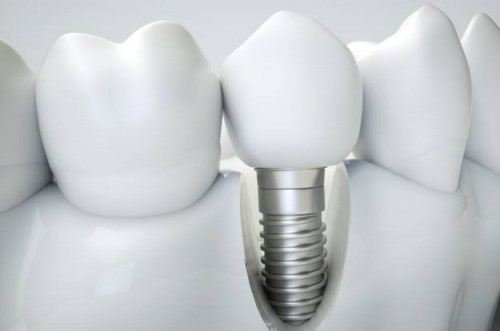 răng implant có khó vệ sinh không