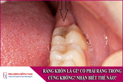 Răng khôn là gì? Có phải răng trong cùng không? Nhận biết thế nào?