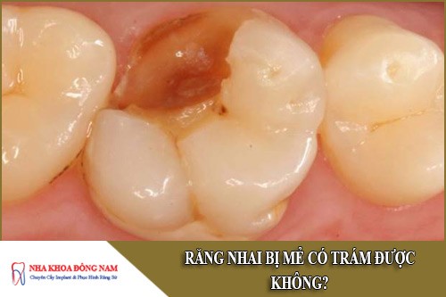 răng nhai bị mẻ có trám được không