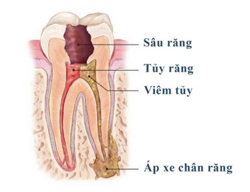 viêm tủy răng nhai