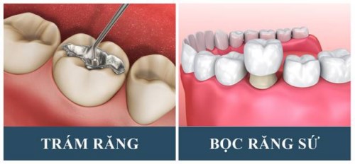 cách khắc phục răng nhai bị nhói đau khi ăn