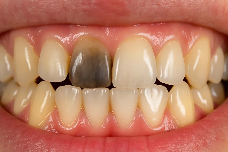 Răng viêm tủy bọc sứ giúp duy trì tuổi thọ được lâu hơn