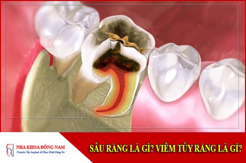 Sâu răng là gì? Viêm tủy răng là gì?