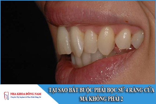 tại sao phải bọc sứ 4 răng cửa mà không phải 2
