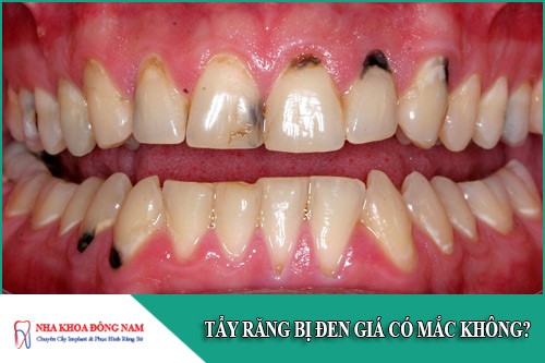 tẩy răng bị đen giá có mắc không