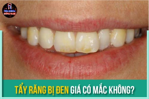 tẩy răng bị đen giá có mắc không