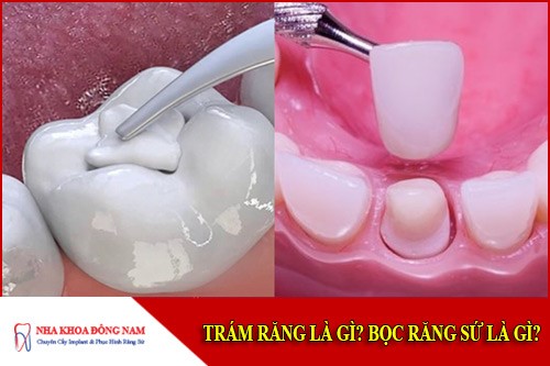 Trám răng là gì? Bọc răng sứ là gì?