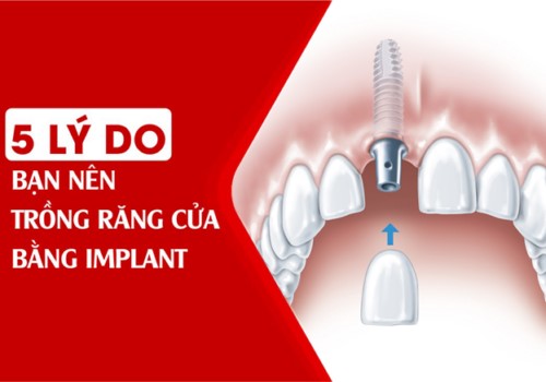 5 lý do bạn nên trồng răng cửa bằng implant