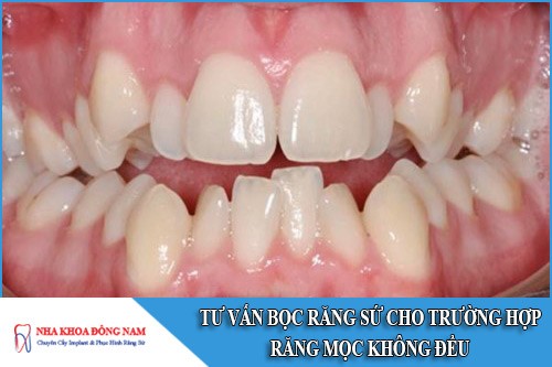 Tư vấn bọc răng sứ cho trường hợp răng mọc không đều