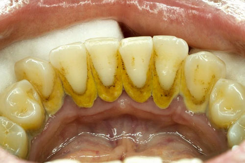 Vi khuẩn trong mảng bám, vôi răng là nguyên nhân chính gây viêm nướu