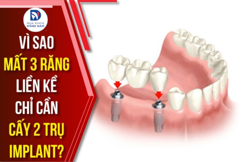 Vì sao mất 3 răng liền kề chỉ cần cấy 2 trụ Implant