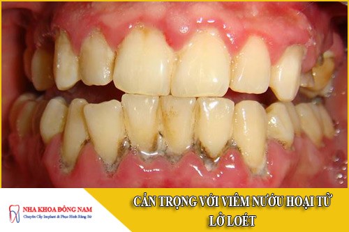 viêm nướu hoại tử lở loét