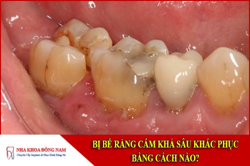 Bị bể răng cấm khá sâu khắc phục bằng cách nào