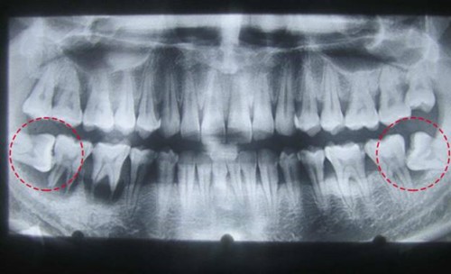 đau răng cấm do răng khôn mọc lệch