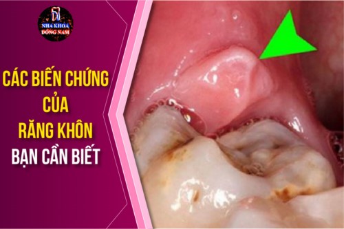 các biến chứng của răng khôn bạn cần biết