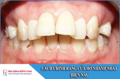 cách chỉnh răng cửa hô nhanh nhất hiện nay