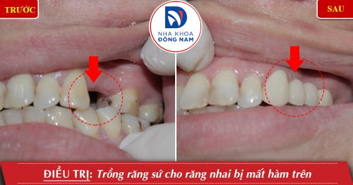 Phục hình cầu răng sứ cho bệnh nhân mất răng nhai hàm trên