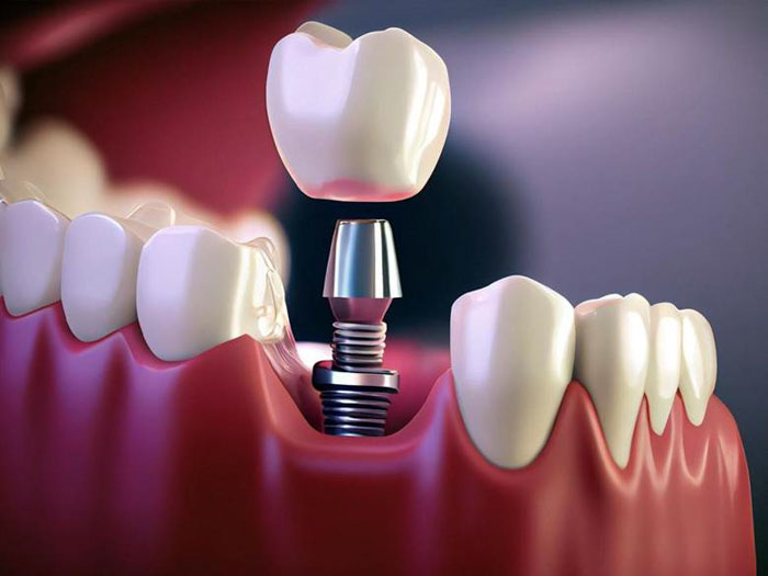 Cấy ghép Implant là giải pháp trồng răng giả toàn diện nhất