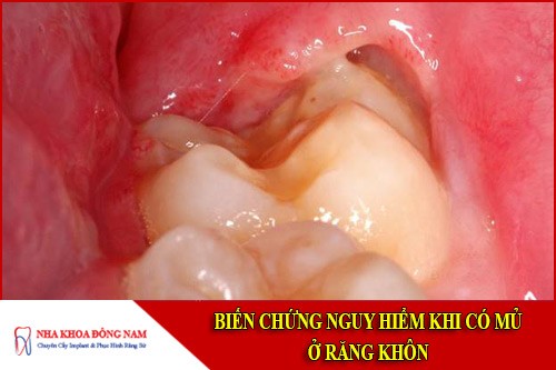 Có mủ ở răng khôn: Cảnh báo biến chứng nguy hiểm