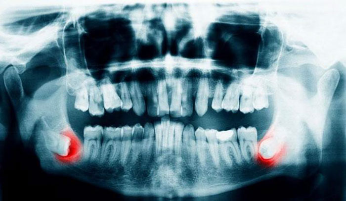 Đa phần các trường hợp mọc răng khôn đều cần phải nhổ bỏ