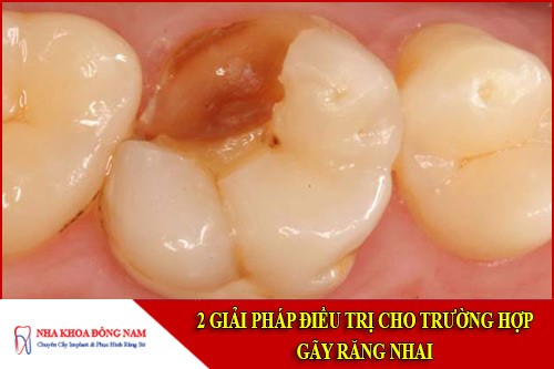 2 Giải pháp điều trị cho trường hợp gãy răng nhai