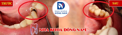 bọc sứ răng cấm bị sâu