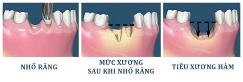 tiêu xương hàm