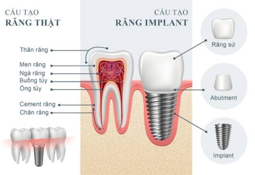cấu tạo răng implant