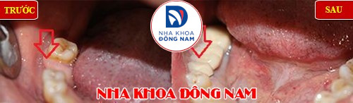 phục hình răng cấm bằng cầu sứ