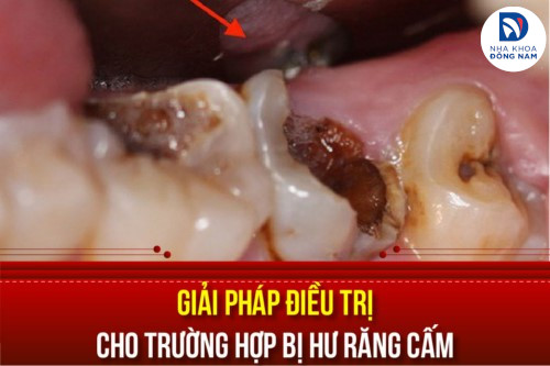 các giải pháp điều trị cho trường hợp bị hư răng cấm