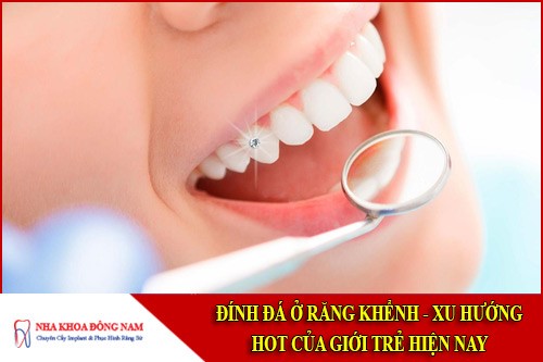 Đính đá ở răng khểnh - Xu hướng HOT của giới trẻ hiện nay
