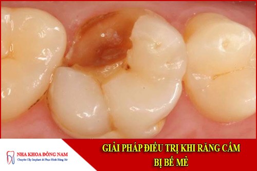 Giải pháp điều trị khi răng cấm bị bể mẻ
