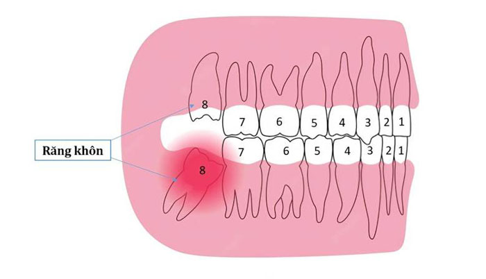 Hình minh họa vị trí của răng khôn