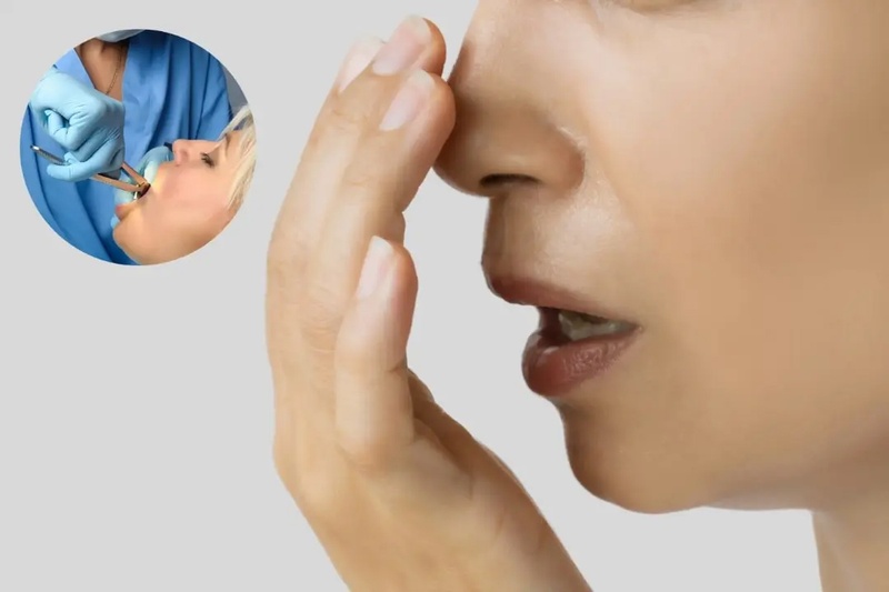 Hôi miệng thường gặp sau nhổ răng do nhiều nguyên nhân