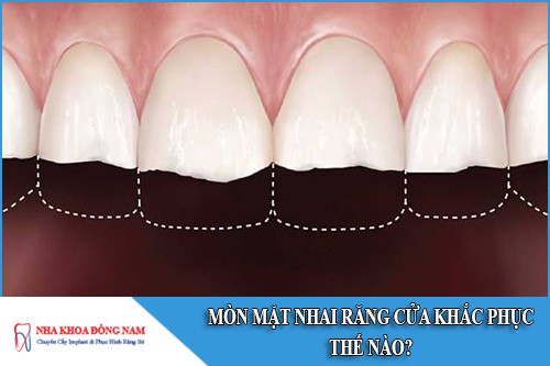 mòn mặt nhai răng cửa khắc phục thế nào
