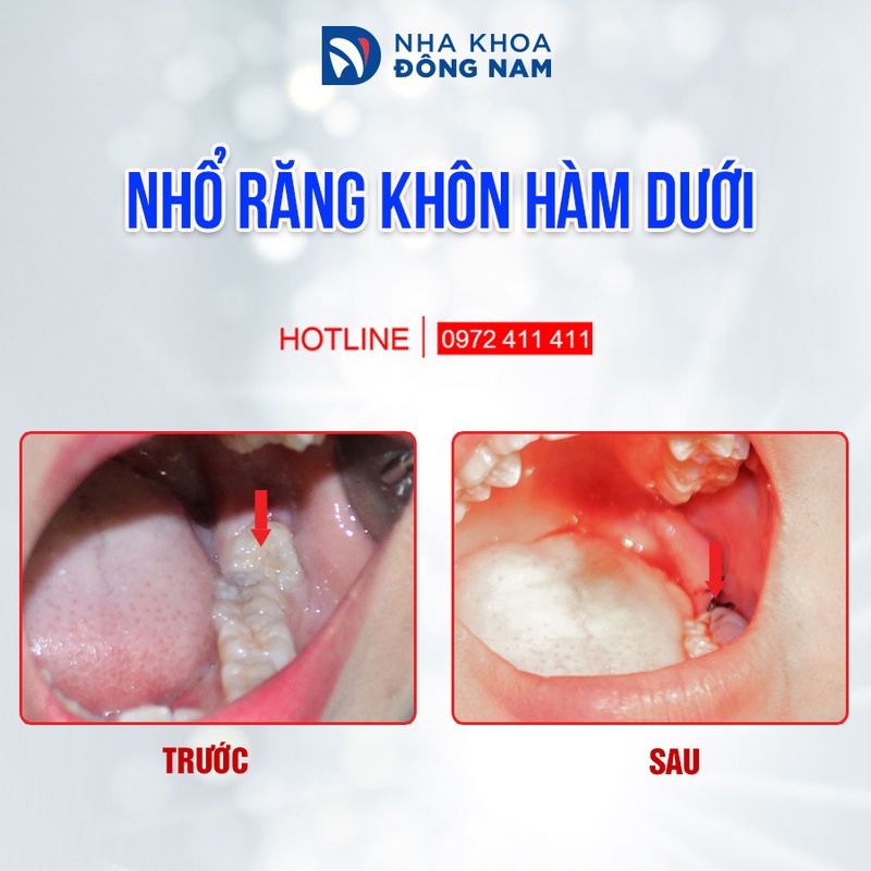 Nhổ răng khôn hàm dưới mọc lệch