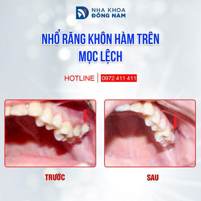 Nhổ răng khôn nhanh chóng lành thường nhanh tại nha khoa Đông Nam