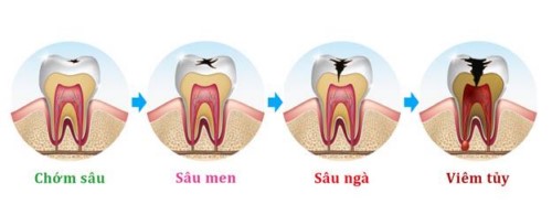 quá trình sâu răng