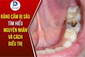 răng cấm bị sâu - nguyên nhân và cách điều trị