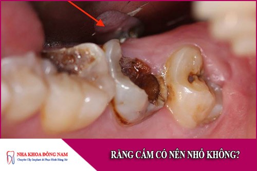 răng cấm có nên nhổ không