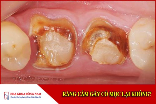 Răng cấm gãy có mọc lại không