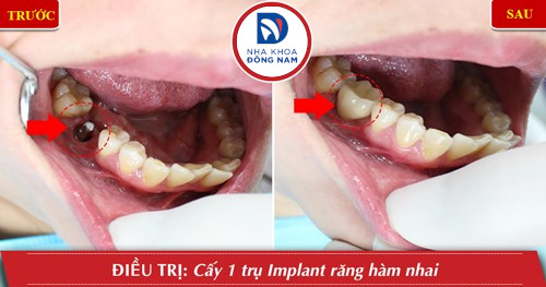 trồng răng cấm bằng implant