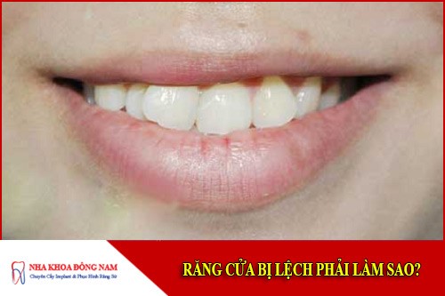 răng cửa bị lệch phải làm sao