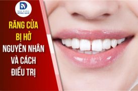 Răng cửa hở: Nguyên nhân và cách điều trị