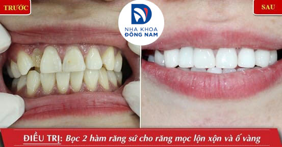 răng cửa mọc lệch vào trong