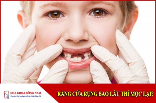 Răng cửa rụng bao lâu thì mọc lại