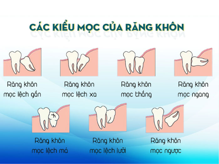 Răng khôn có nhiều dạng mọc sai lệch