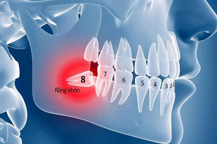 Răng khôn là chiếc răng mọc cuối cùng nằm sát vách hàm