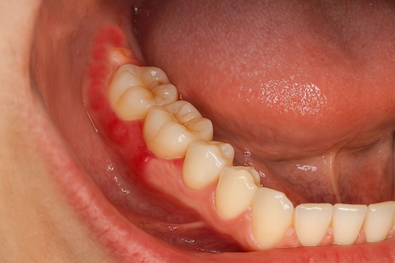 Răng khôn mọc lệch có thể gây đau nhức